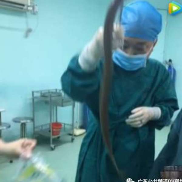 The man almost died after he inserted a live eel as a folk cure for constipation Photo: Handout