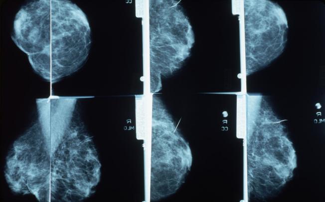 Breast-cancer screening saves 1,300 women yearly. Photo: CORBIS