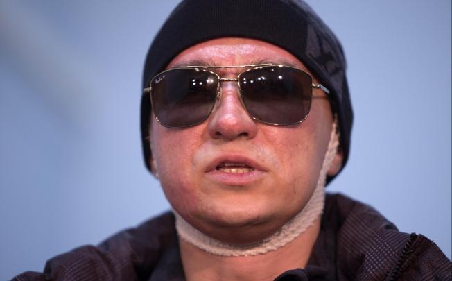 Sergei Filin had acid splashed on his face last month. Photo: AP