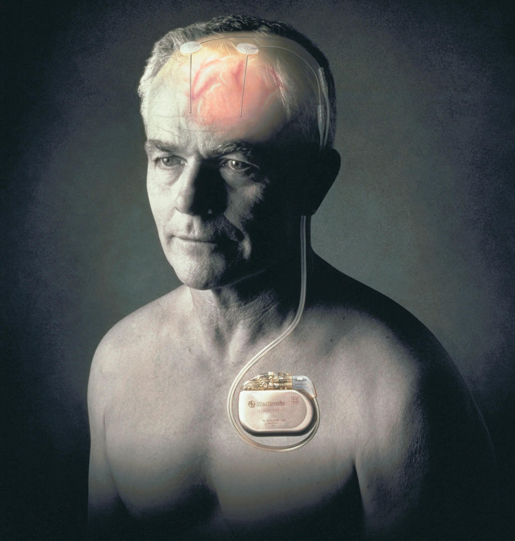 Deep brain stimulation uses a surgically implanted medical device, similar to a pacemaker, to deliver mild electrical pulses to precisely targeted areas of the brain.