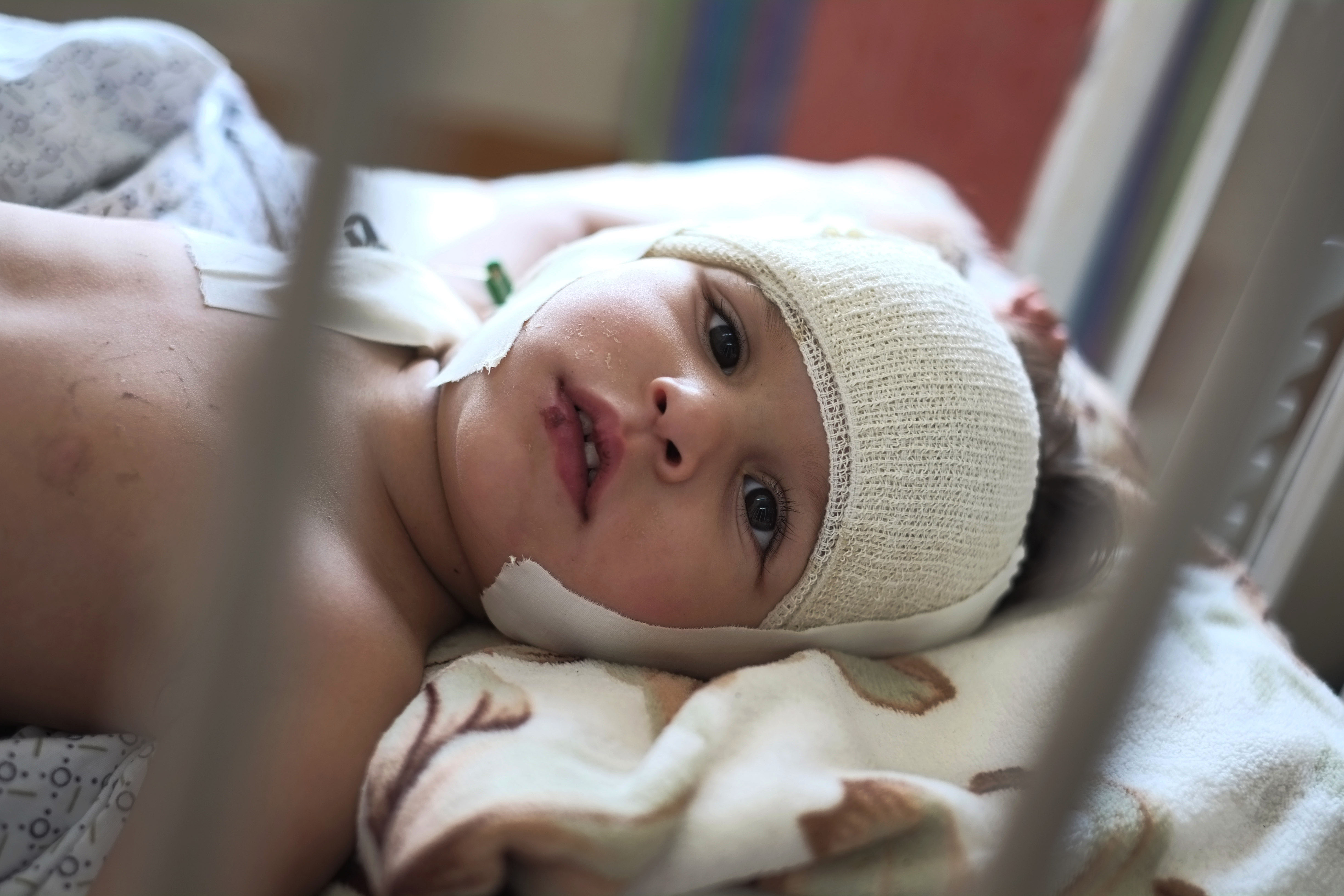 Palestinian Sama al-Ajouz, 2, lays on a hospital bed in Gaza City. Al-Ajouz was wounded by shrapnel on the scull during an Israeli strike. Photo: AP