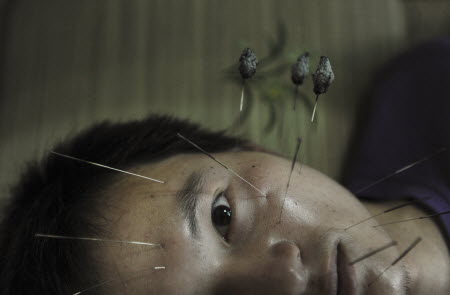 The number of smokers seeking help to quit through acupuncture has fallen, despite more mobile treatment clinics being set up across the city. Photo: Reuters