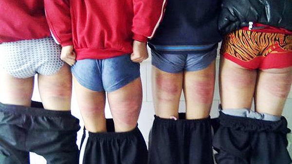 Students at a martial arts school in Henan display welts on the backs of their legs inflicted by their teachers. Violence against children, by parents or teachers, is a growing area of public concern in China. Photo: Weibo