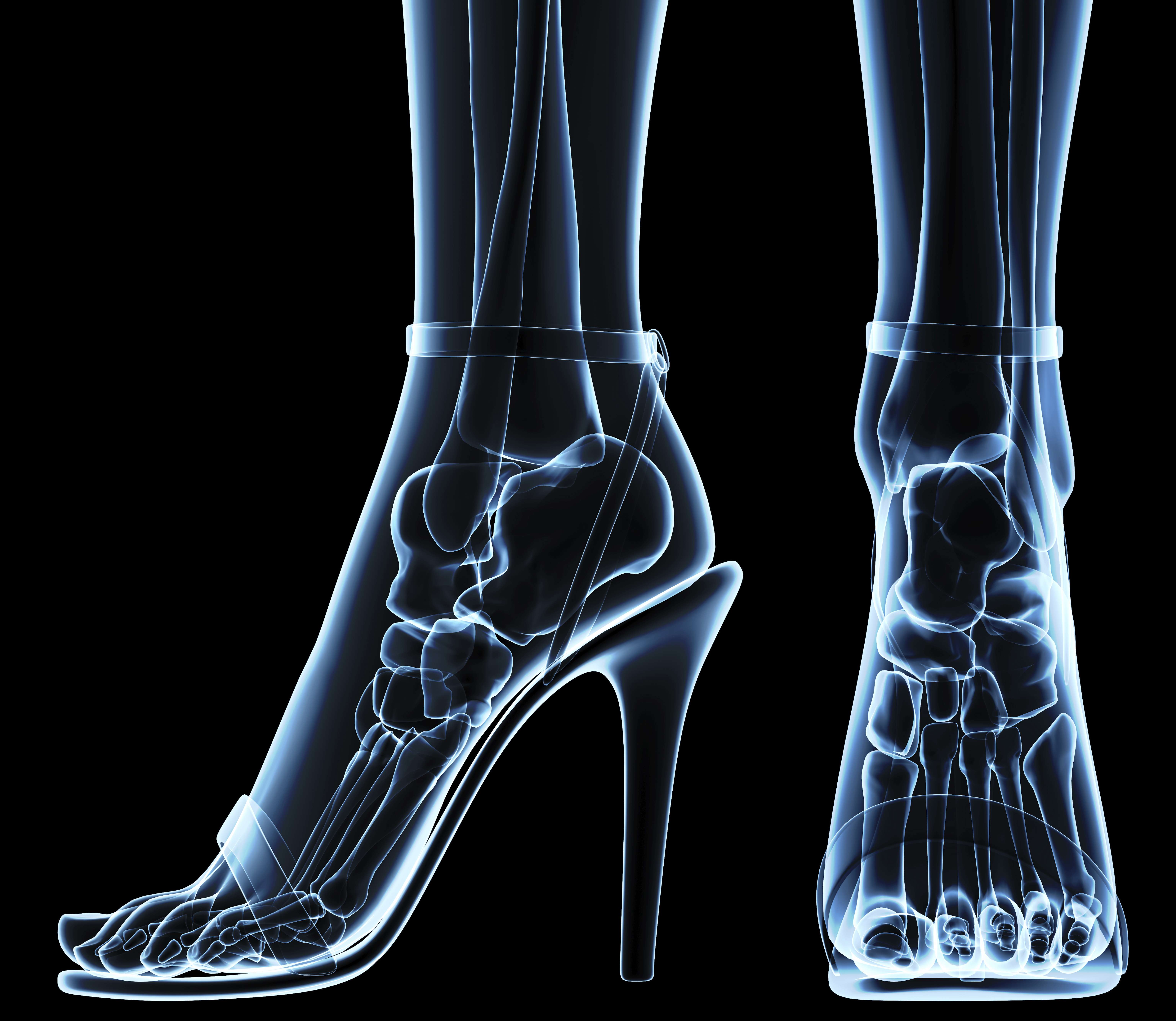 High heels may be fashionable, but they’re not healthy for the human feet.