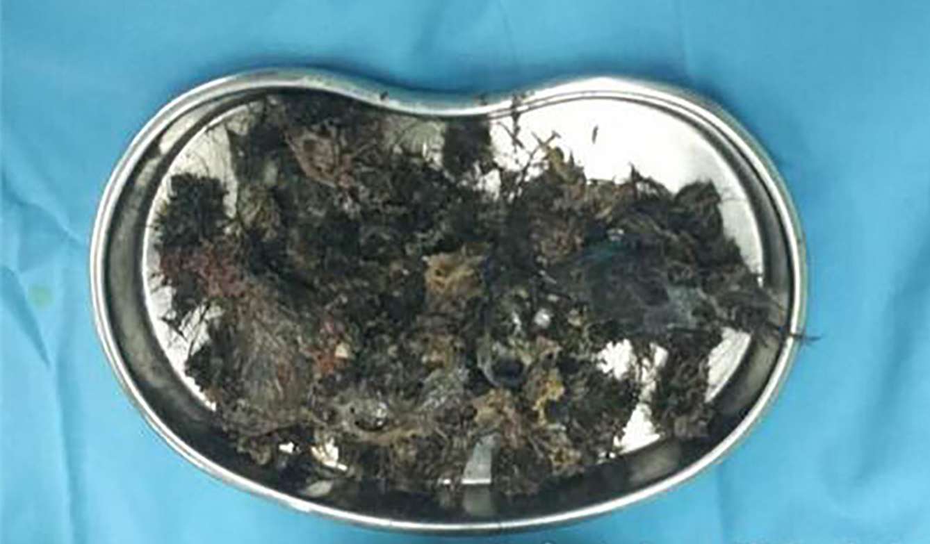 Balls of hair were removed from a child’s stomach. Photo: SCMP Pictures