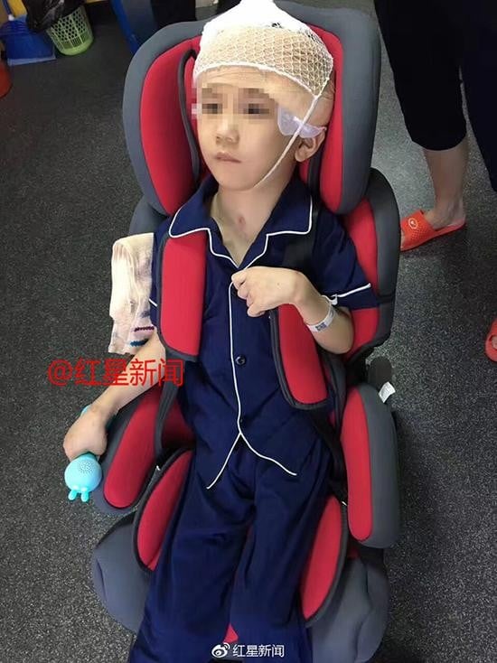 Six-year-old Pengpeng has undergone surgery to ease the pressure on his skull from a build-up of blood. Photo: Handout