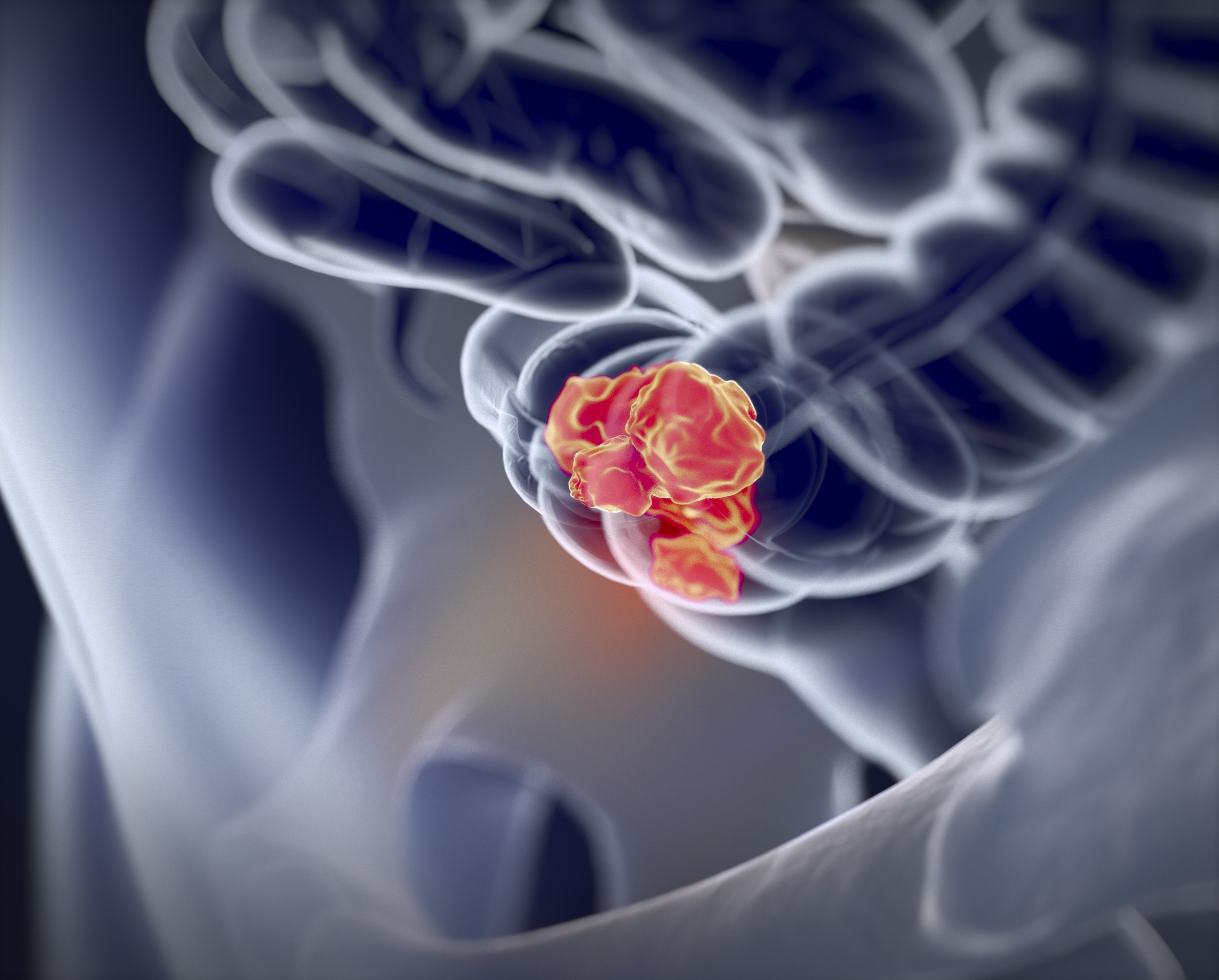 A 3D illustration of colorectal cancer. Photo: Shutterstock