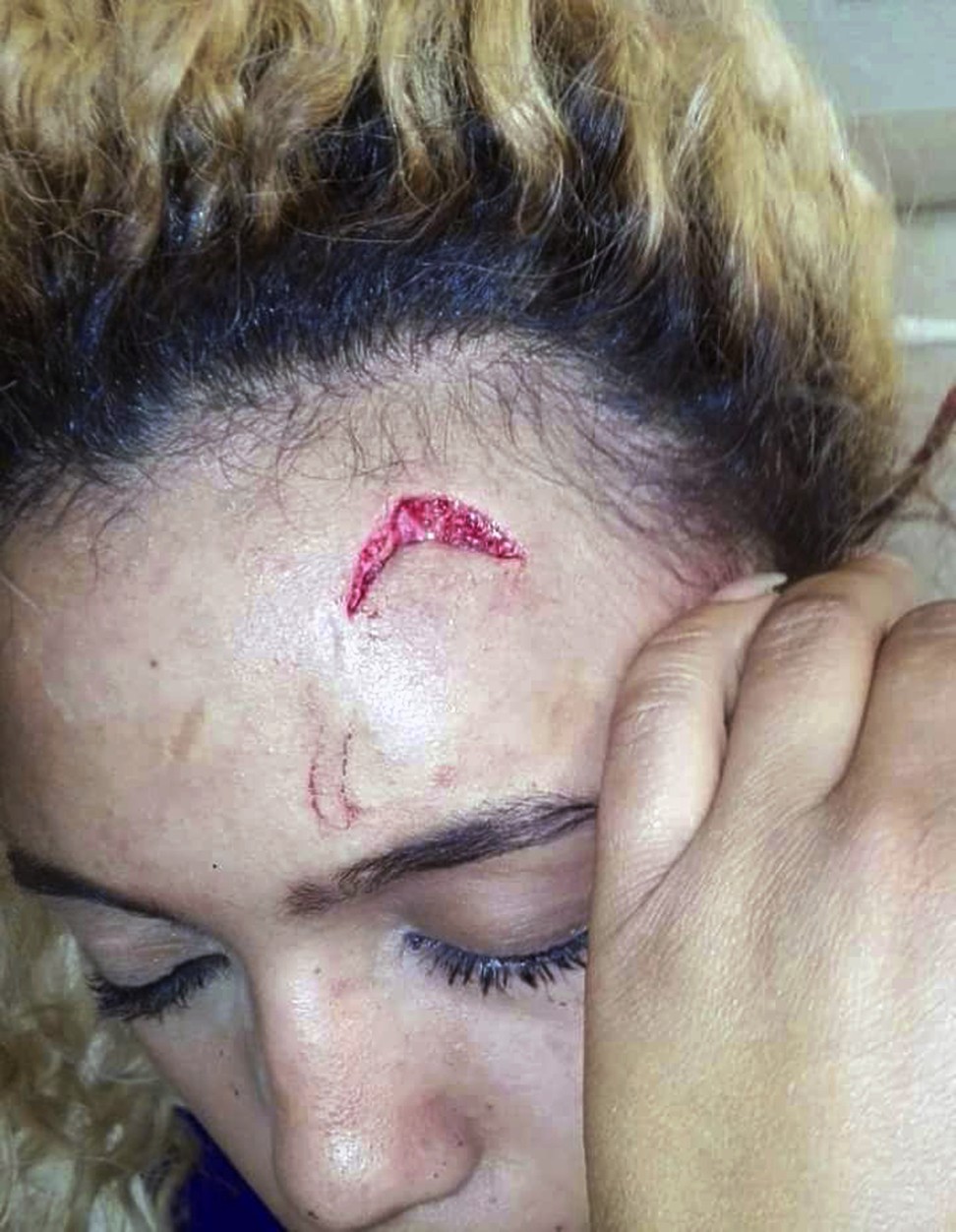 Gabriella Engels is seen with an injury to her forehead in Johannesburg, South Africa. Engels has accused Grace Mugabe of assaulting her on Sunday while she was visiting Mugabe's sons in a hotel room. Photo: Debbie Engels via AP