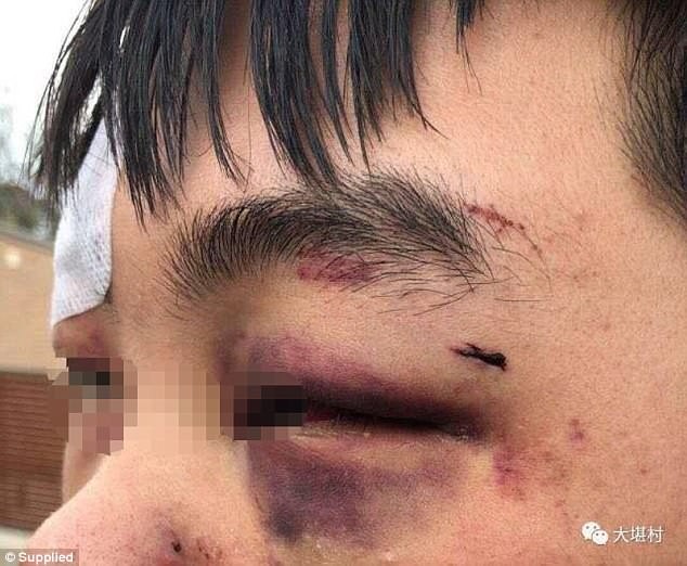 Pictures of the injuries suffered by three Chinese high school students in Canberra, Australia, have surfaced online. Photo: Internet