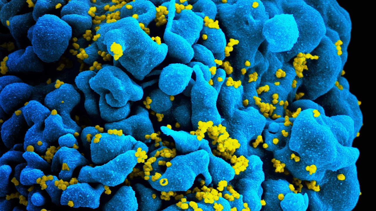 Scanning electromicrograph of an HIV-infected T cell. Photo: NIAID