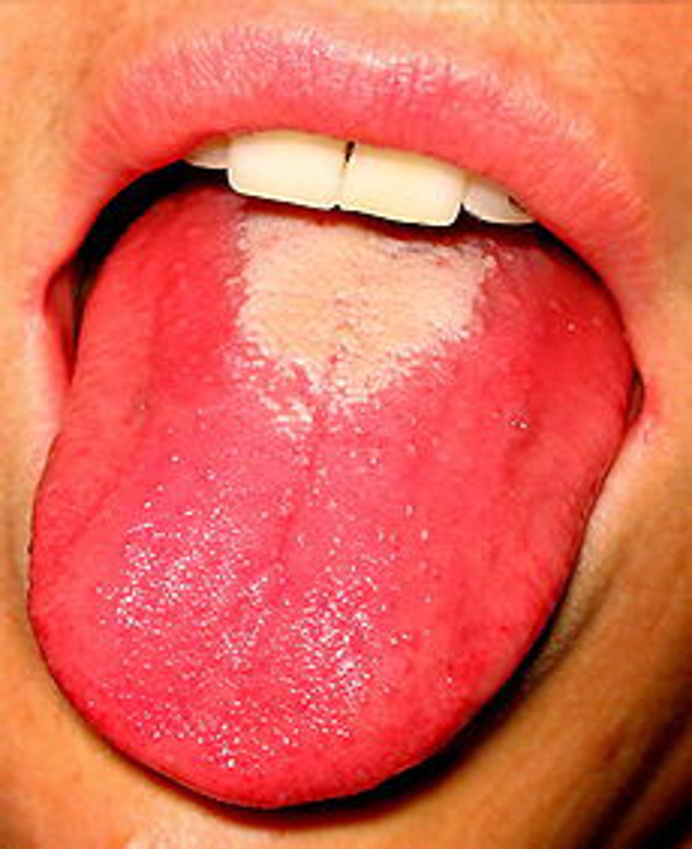 A “strawberry tongue” is one symptom of the disease.