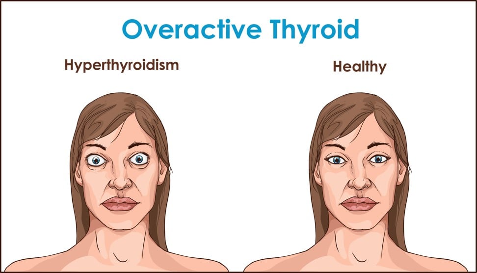 Diseases such as hyperthyroidism (Graves disease) present various eye-related symptoms. Image: Alamy