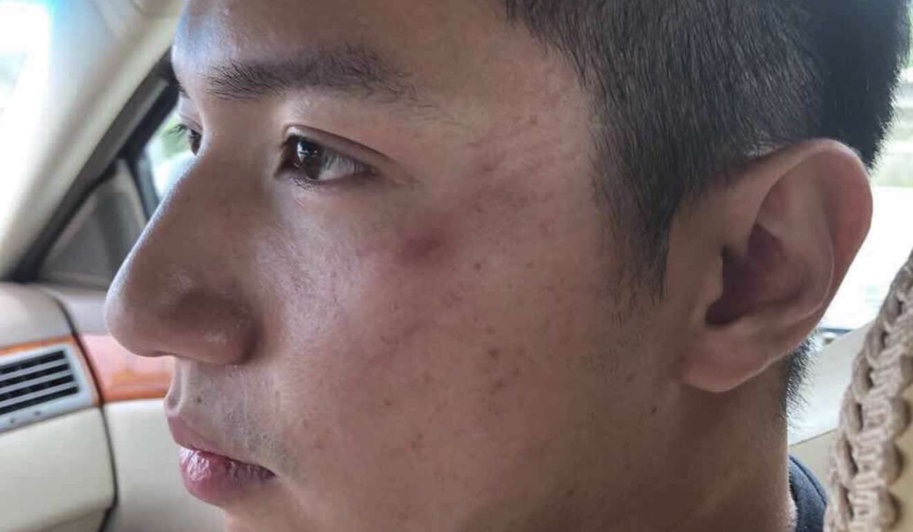 Chan was visibly shaken and showed in a video red marks on his left cheek. Photo: Handout