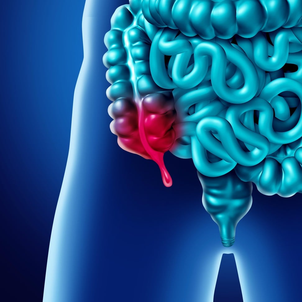 3D illustration of an inflamed appendix. Photo: Alamy