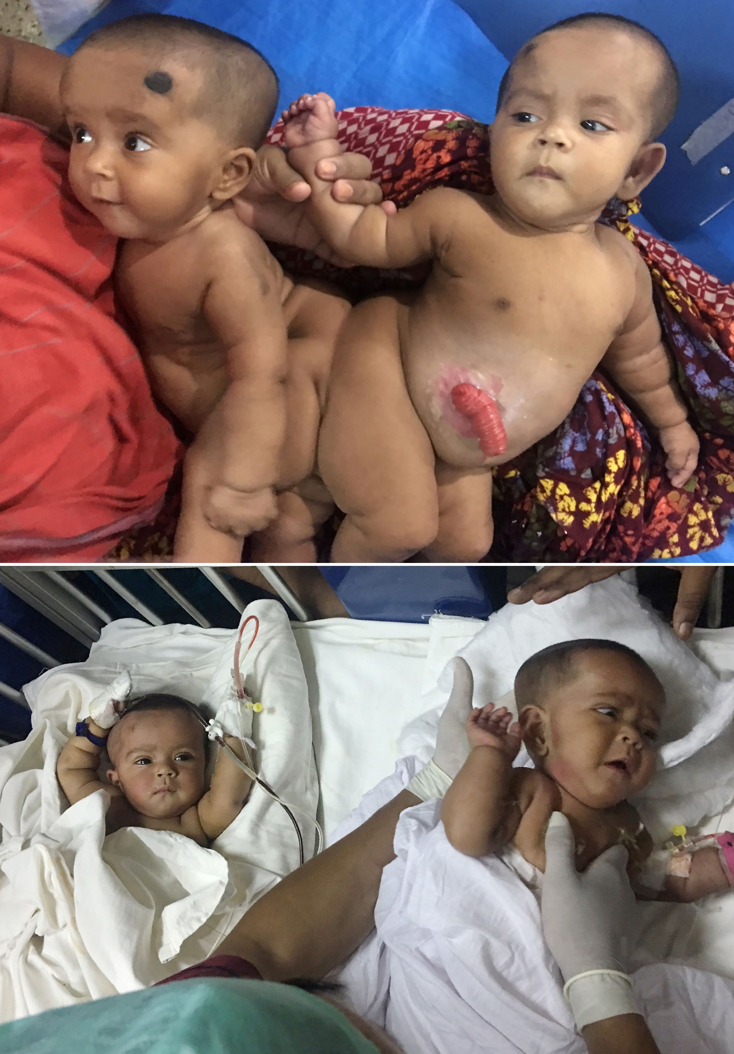 Bangladeshi Conjoined Twins Going Home 18 Months After Being Separated In The Country S First Such Surgery South China Morning Post