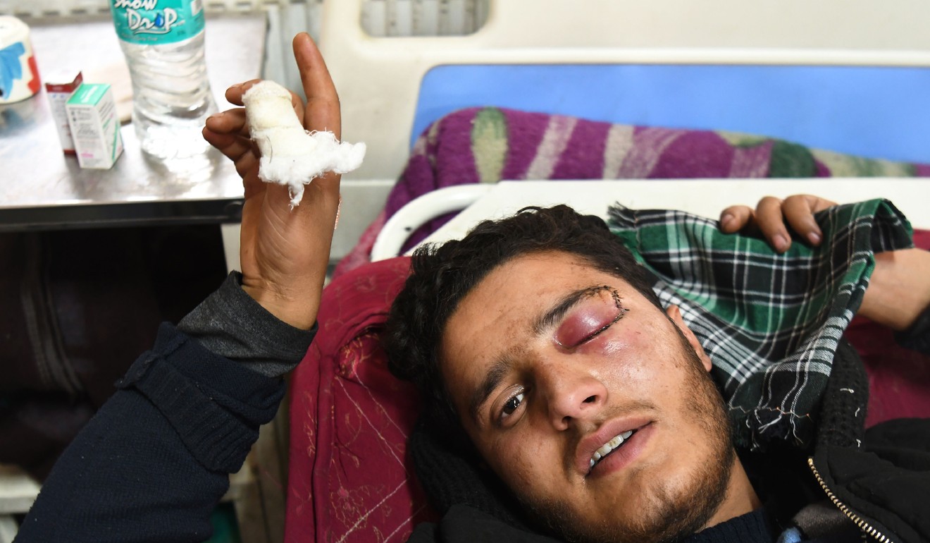 Shahid Ahmad, 16, rests on a bed in Srinagar's main hospital after his left eye was damaged by pellet gun fired by Indian government forces. Photo: AFP