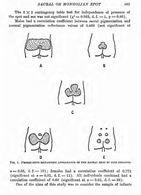 âMongolian spotsâ were another characteristic said to belong to the âyellowâ race. Photo: Handout