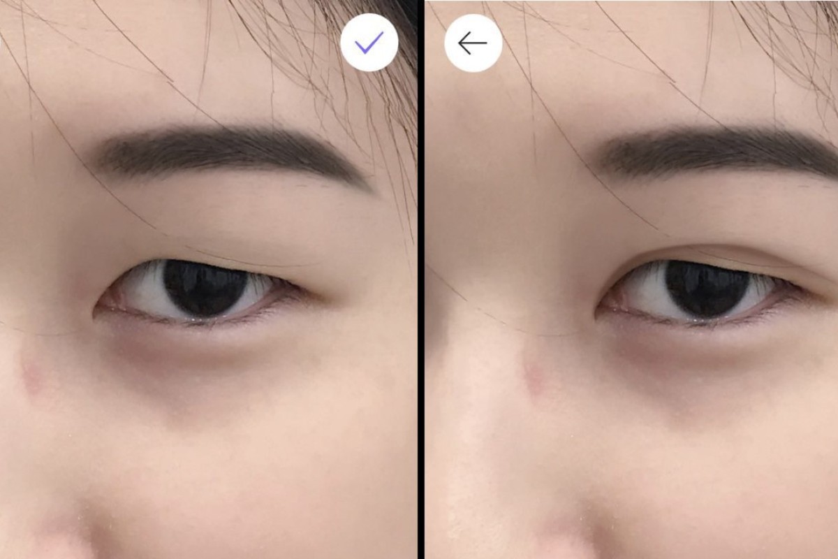 how to remove double eyelid