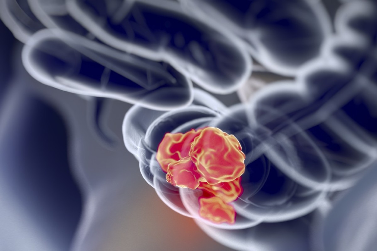 Nearly 300 colorectal cancer cases identified in Hong Kong screening