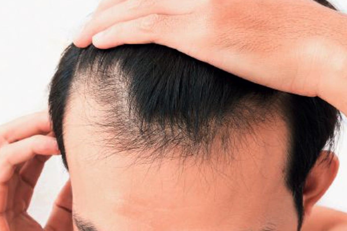 Chinese people losing their hair earlier than ever before, research shows - South China Morning Post