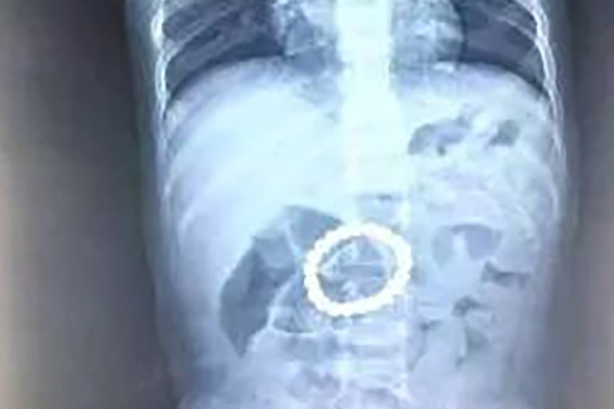 Surgeons at Beijing Childrens Hospital removed a ring of 21 magnetic balls from a toddlers stomach. Photo: Weibo
