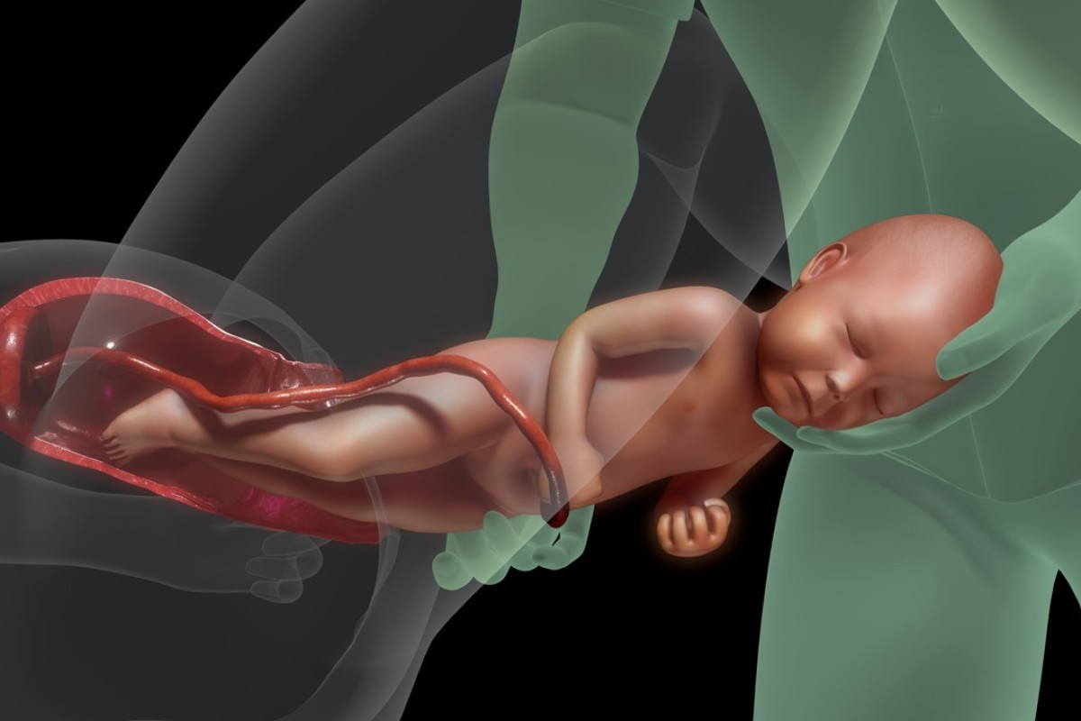 Women's birth canals vary in size and shape the world over, but medical training is based on Europeans | South China Morning Post Women's birth canals vary in size and shape the world over, but medical training is based on Europeans | South China Morning Post