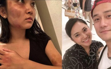 Haruka Nakaura shows the bruises on her face, arms and body (left) and earlier, with Jiang Jinfu. Photo: Shanghaiist