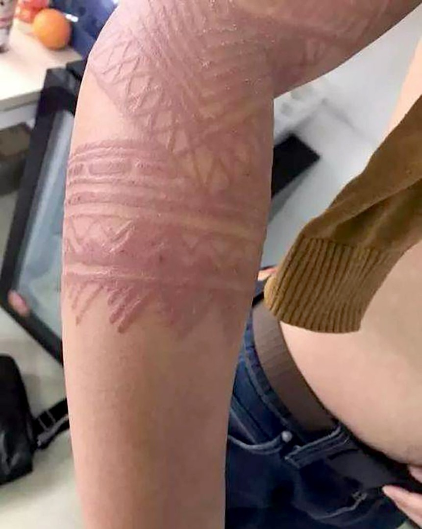 Bali Tourists Warned Fake Henna Tattoos Could Put Lives At Risk