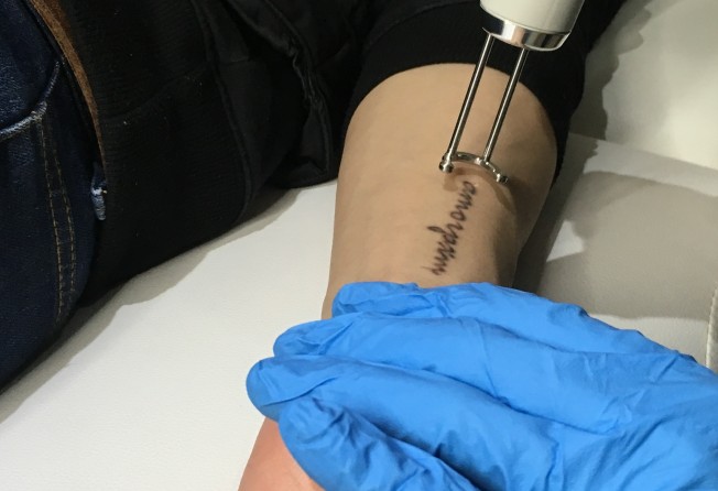 Why Laser Tattoo Removal Is On The Rise And Why You Should Think Twice Before Getting Inked In The First Place South China Morning Post