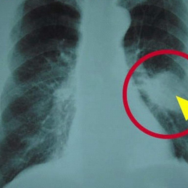 Gene tests 'critical' for diagnosing lung cancer South