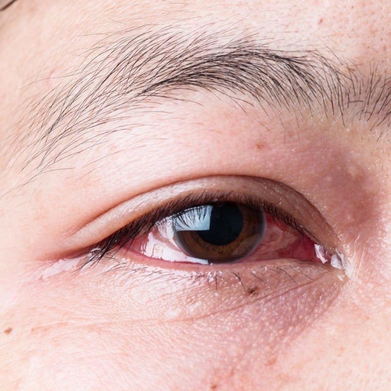 Inflammatory eye condition iritis should be treated ...
