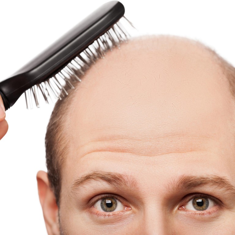 Trick To Regrowing Lost Hair Might Be Tearing Out What You Have