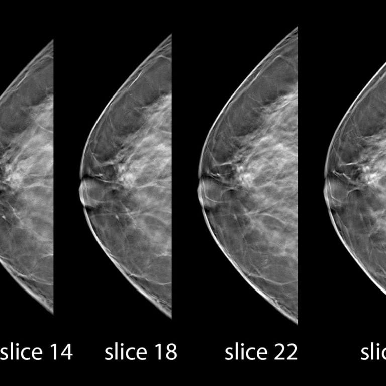 mammogram+over+50