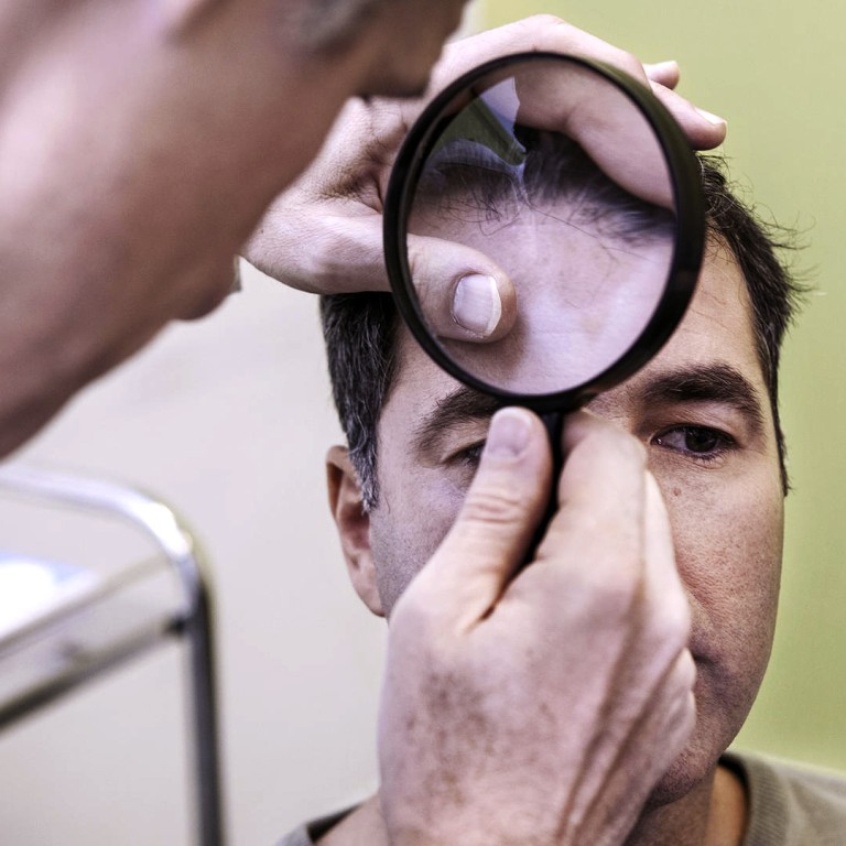The Bald Facts About Diet To Avoid Hair Loss You Need Meat