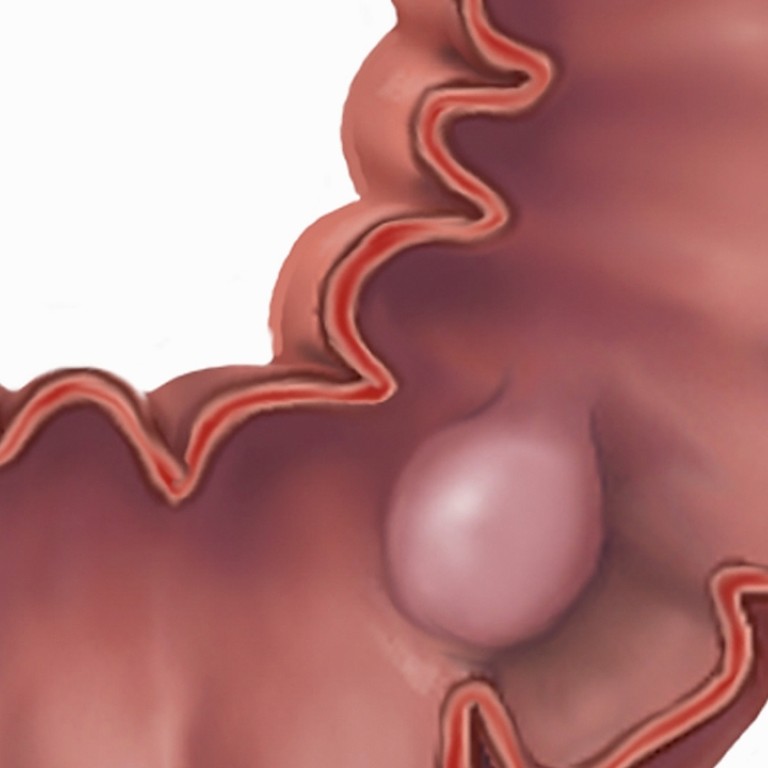 How To Spot Symptoms Of Colorectal Cancer The Second Most Common Cancer In Hong Kong South China Morning Post