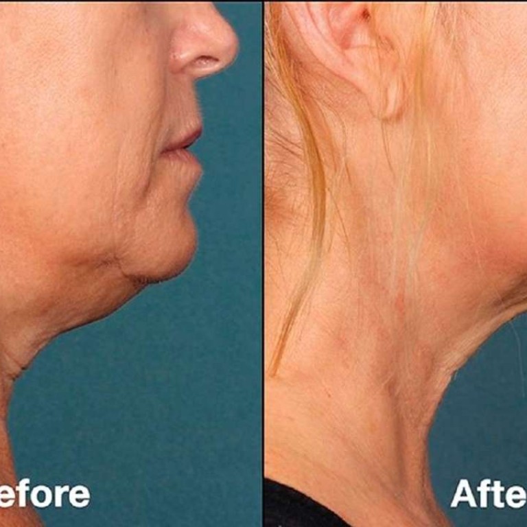 More fat profits? The makers of Botox say they have a cure for your double chin | South China Morning Post More fat profits? The makers of Botox say they have a cure for your double chin | South China Morning Post