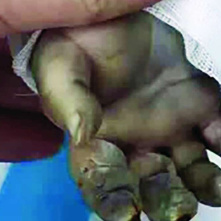 Unattended Baby Badly Burned After Hairdryer Left Running Beside