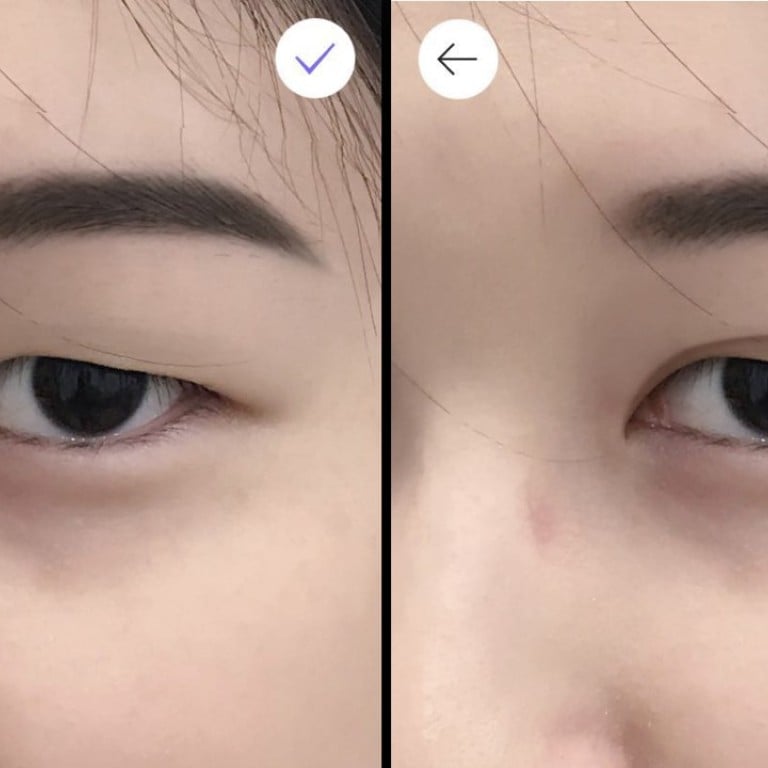 chinese double eyelid surgery