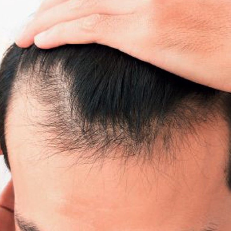 Chinese people losing their hair earlier than ever before, research shows |  South China Morning Post