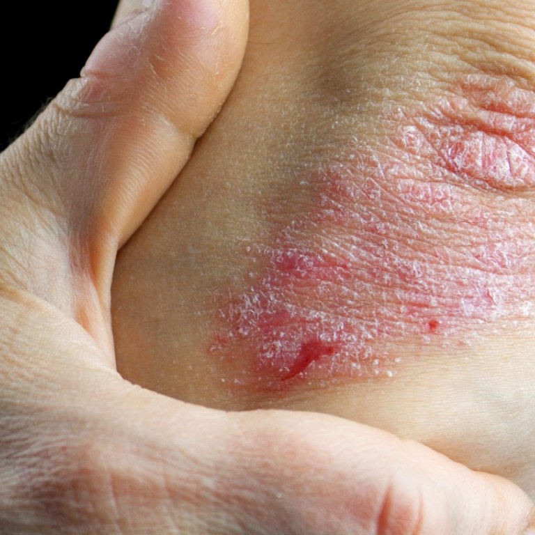 Psoriasis Patients In Hong Kong Seek Quicker Access To Better