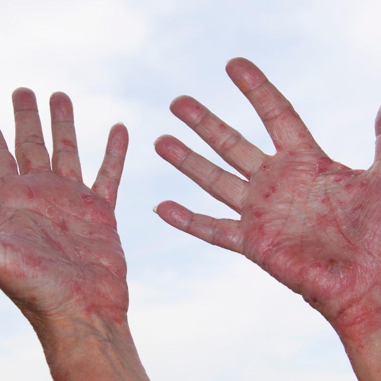 Eczema Its Causes How To Get Relief From The Itching And The