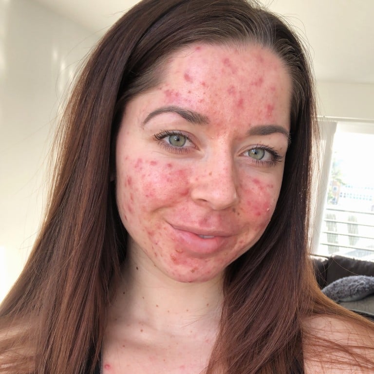 Acne Why Some Adults Have It How To Treat It And One