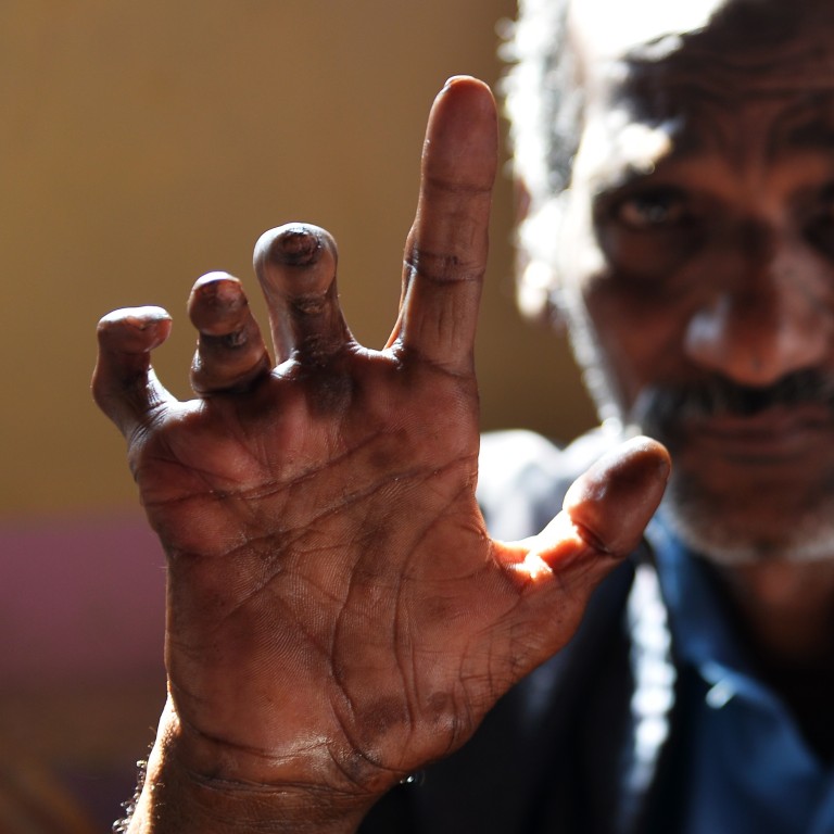 India S Leprosy Disaster Its Millions Of Victims And The Vaccine That Could Stop Many Being Disfigured South China Morning Post