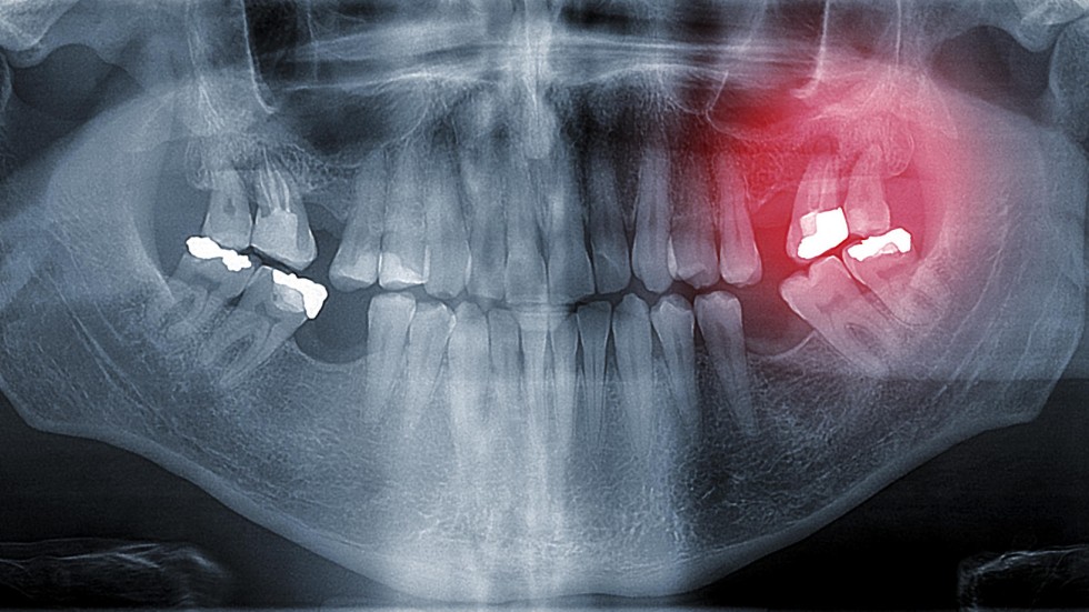 Mercury is toxic, but is still used in amalgam fillings South China