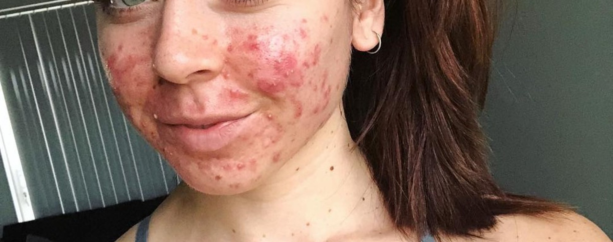 Acne: why some adults have it, how to treat it, and one Instagrammer's battle with chronic acne South China Morning Post