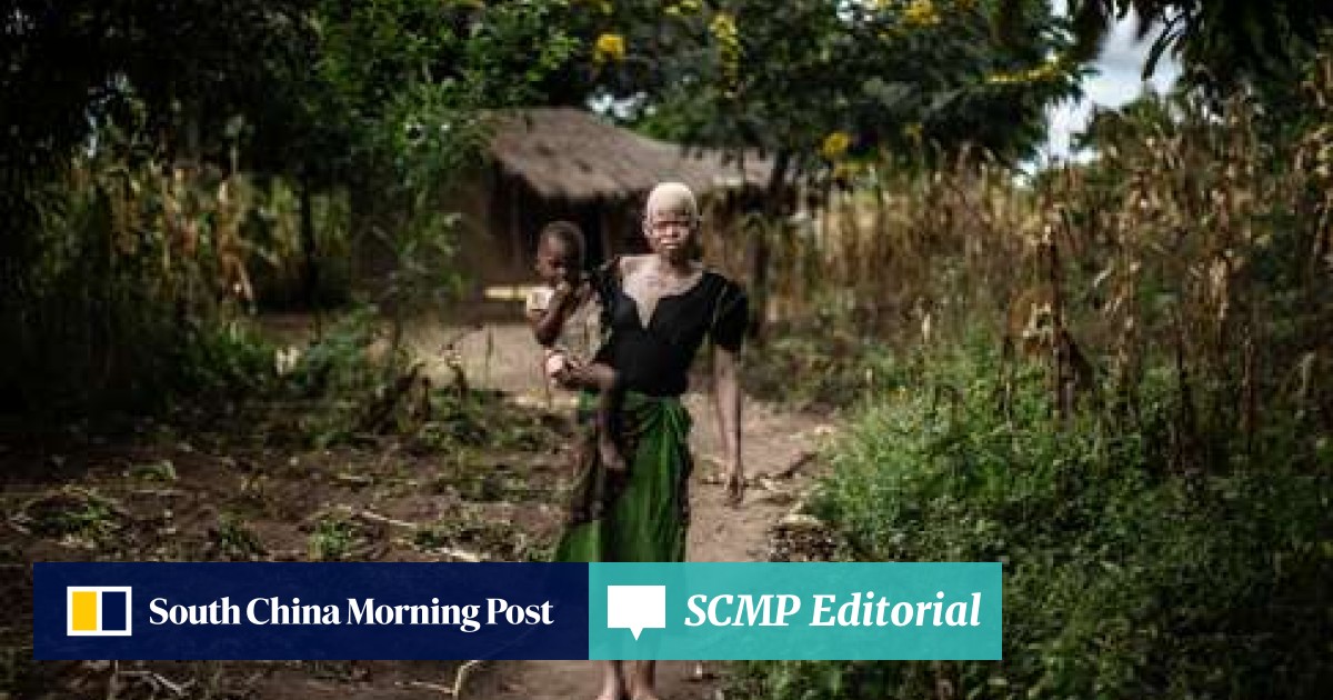 Albinos In Malawi Being Hunted For Their Body Parts For Witchcraft