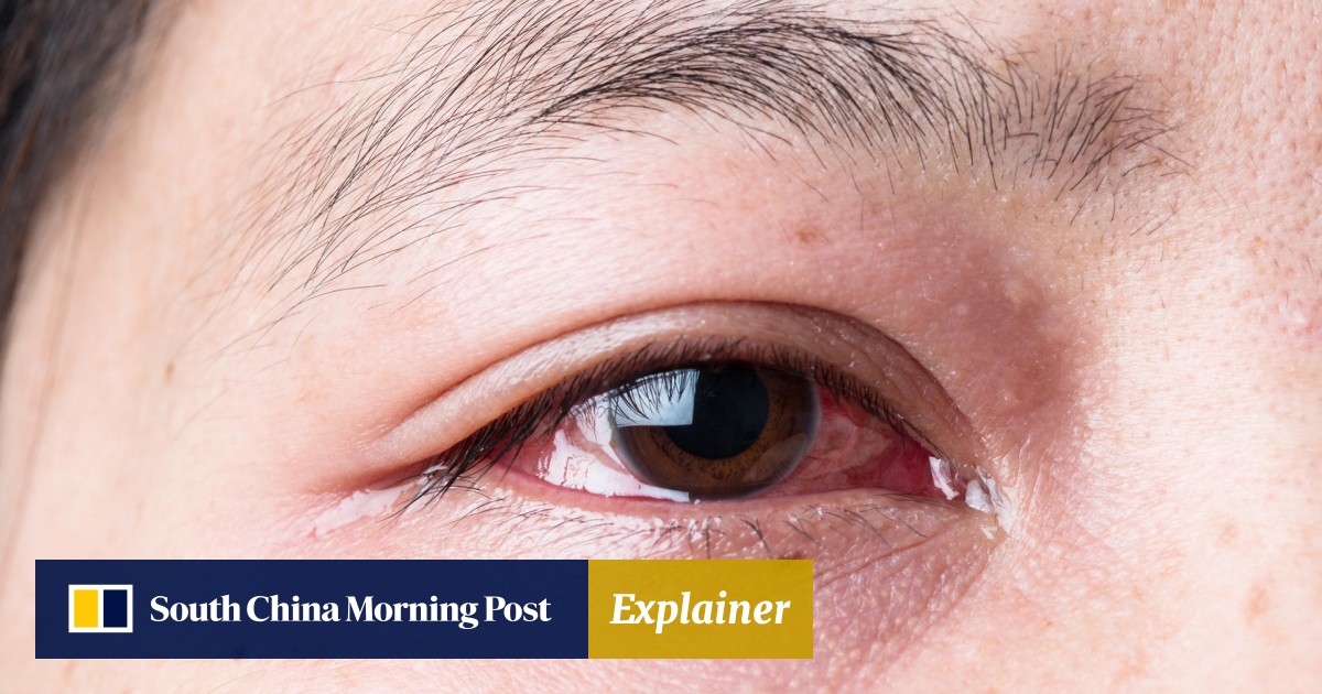 eyelid inflammation