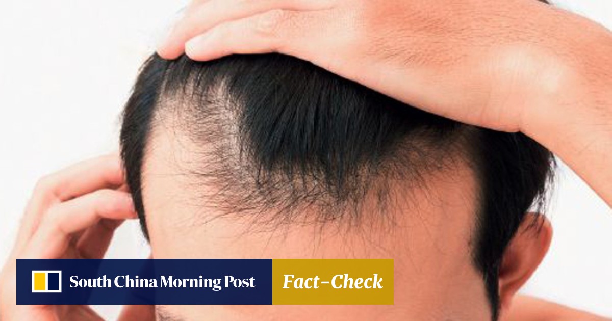 Chinese People Losing Their Hair Earlier Than Ever Before