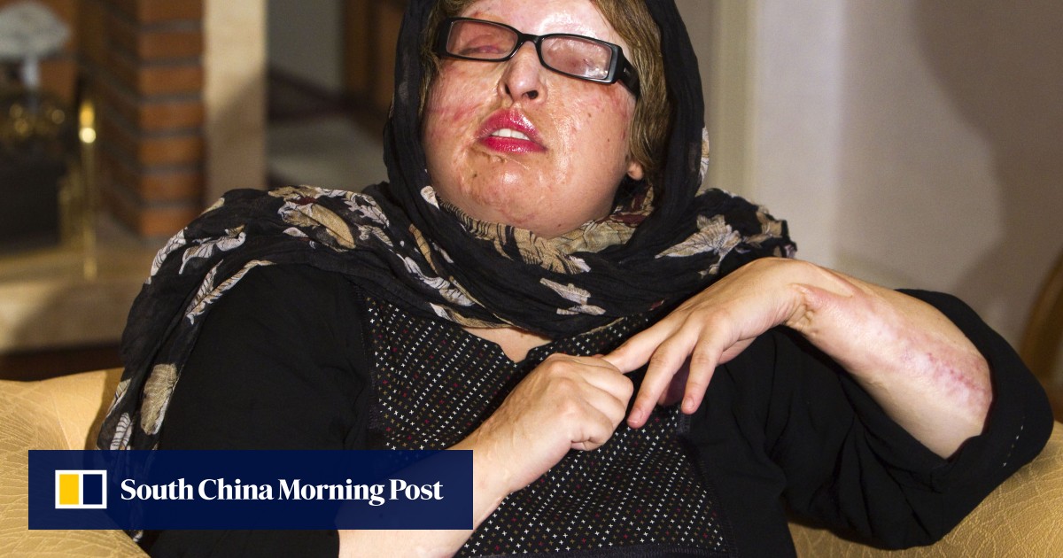 Blind justice Iranian man’s eye is gouged out as punishment for acid