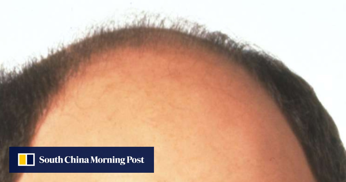 Short, white men are more likely to go bald, study finds South China